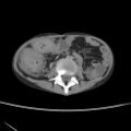 Colocolic fistula - Crohn disease (Radiopaedia 57063-63955 A 45).jpg