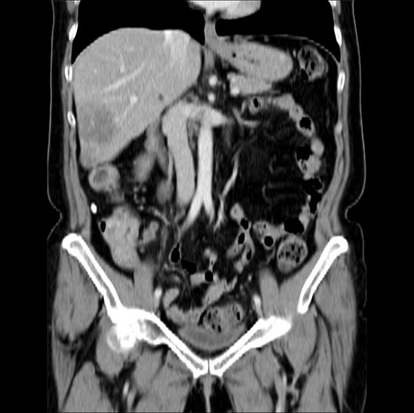 File:Colon carcinoma with hepatic metastases (Radiopaedia 29477-29961 B 21).jpg