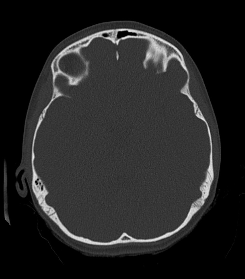Nasoorbitoethmoid fracture (Radiopaedia 90044-107205 Axial bone window 93).jpg