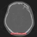 Nasopharyngeal carcinoma recurrence - skull base destruction (Radiopaedia 29107-29490 Axial bone window 59).jpg