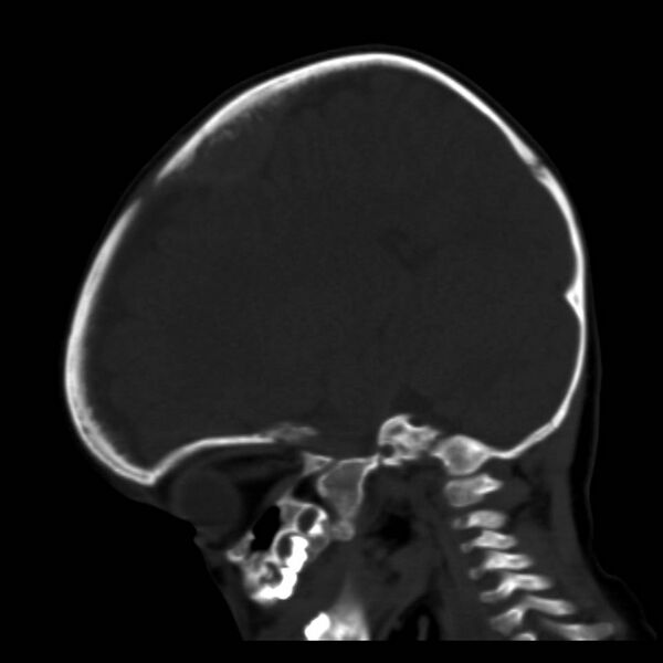 File:Neuroblastoma with skull metastases (Radiopaedia 30326-30958 Sagittal bone window 15).jpg