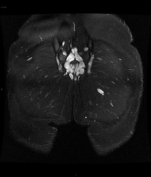 File:Neurofibromatosis type 1 (Radiopaedia 36933-38560 Coronal STIR 5).jpg