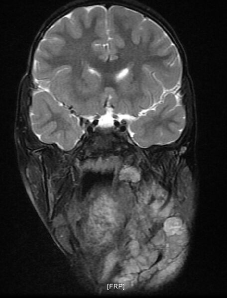 File:Neurofibromatosis type 1 (Radiopaedia 6954-8063 Coronal T2 4).jpg