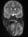 Neurofibromatosis type 1 (Radiopaedia 6954-8063 Coronal T2 4).jpg