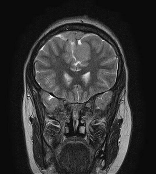 File:Neurofibromatosis type 2 (Radiopaedia 66211-75401 Coronal T2 7).jpg