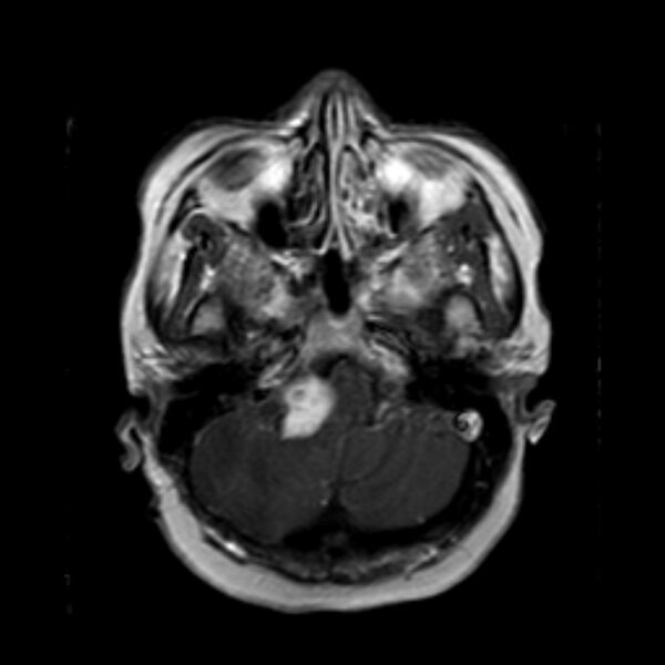 File:Neurofibromatosis type 2 (Radiopaedia 67470-76871 Axial T1 C+ 5).jpg