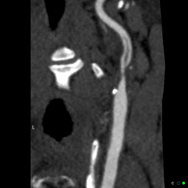 File:Non-occlusive intraluminal internal carotid artery thrombus (Radiopaedia 37751-39658 A 39).jpg