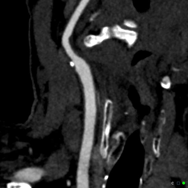 File:Non-occlusive intraluminal internal carotid artery thrombus (Radiopaedia 37751-39658 C 32).jpg