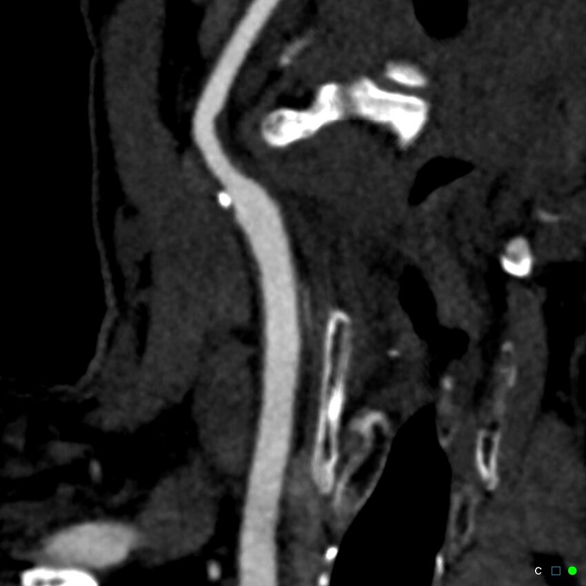 Non-occlusive intraluminal internal carotid artery thrombus (Radiopaedia 37751-39658 C 32).jpg
