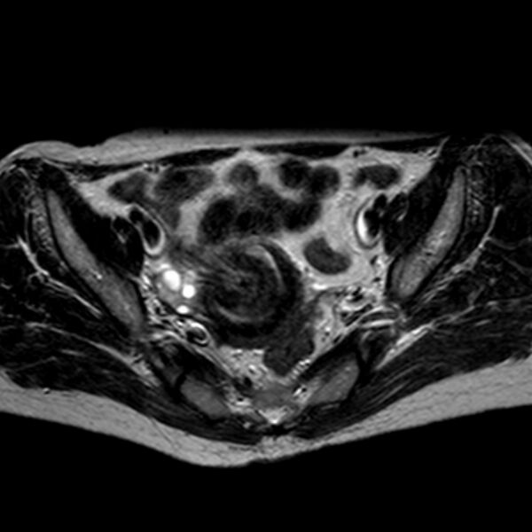 File:Non-puerperal uterine inversion (Radiopaedia 78343-90983 Axial T2 24).jpg
