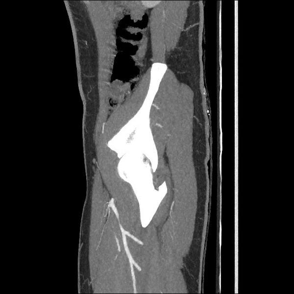 File:Normal CT angiogram of pelvis (Radiopaedia 45390-49430 C 18).jpg