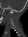 Normal CT cervical spine - pediatric (Radiopaedia 52549-58462 Sagittal bone window 22).jpg