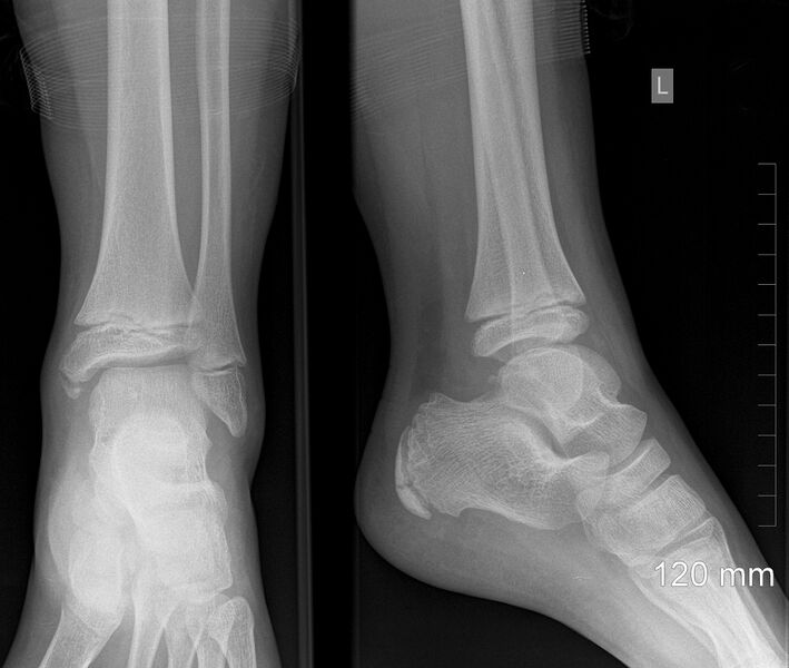 File:Normal ankle x-ray - 11-year-old (Radiopaedia 53474).jpg