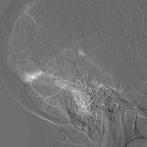 File:Normal cerebral angiogram (four vessel DSA) (Radiopaedia 41708-44649 R 18).png