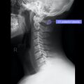Normal cervical spine radiographs (Radiopaedia 32505-96697 A 5).jpeg