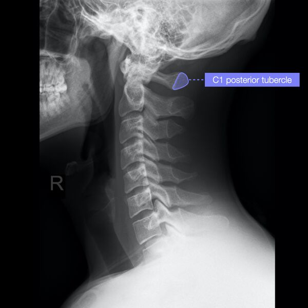 File:Normal cervical spine radiographs (Radiopaedia 32505-96697 A 5).jpeg