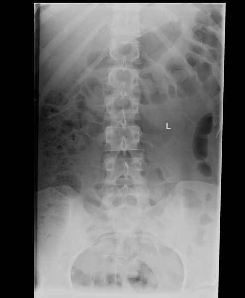 File:Normal lumbar spine CT (Radiopaedia 46533-50985 Frontal 1).png