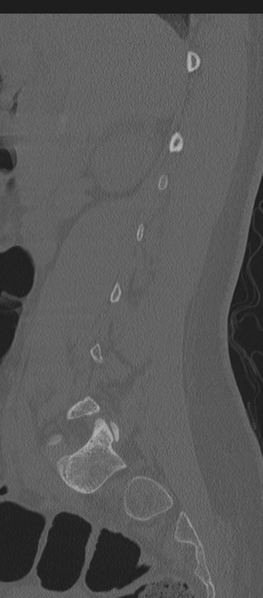 File:Normal lumbosacral CT (Radiopaedia 37923-39867 Sagittal bone window 68).png