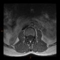 Normal spine MRI (Radiopaedia 77323-89408 Axial T1 1).jpg