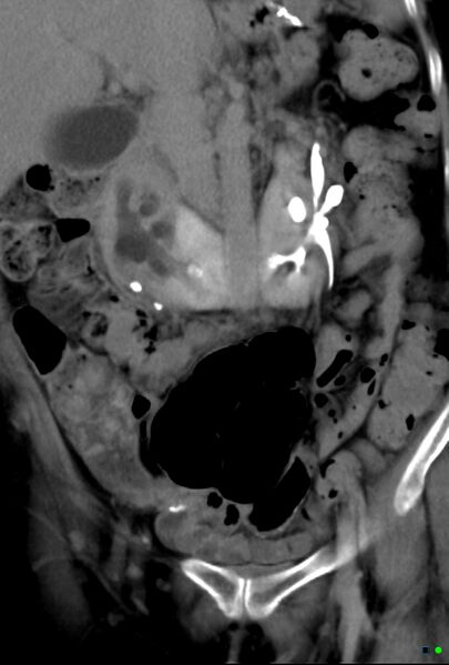 File:Obstructed infected horseshoe kidney (Radiopaedia 18116-17898 G 1).jpg