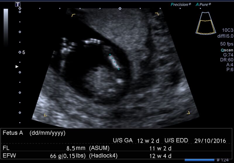 File:1st trimester nuchal-morphology ultrasound (Radiopaedia 44706-48477 General anatomy and NT 35).jpg