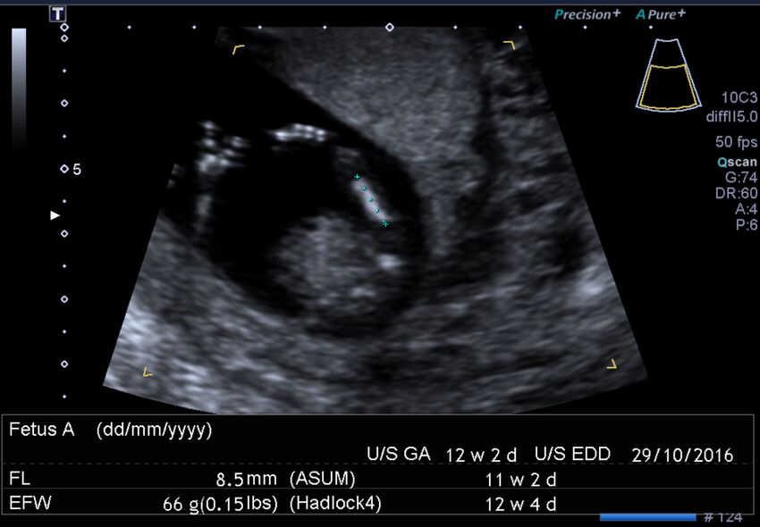 1st trimester nuchal-morphology ultrasound (Radiopaedia 44706-48477 General anatomy and NT 35).jpg