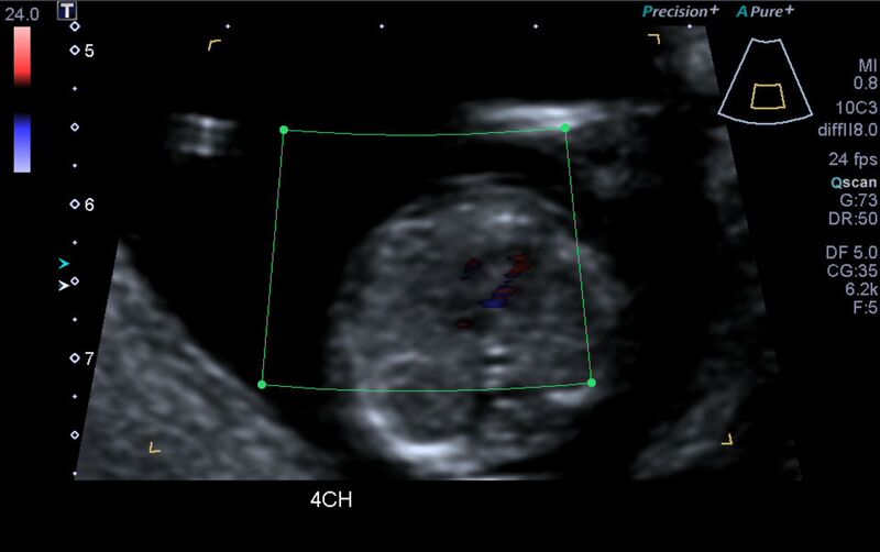File:1st trimester nuchal-morphology ultrasound (Radiopaedia 44706-48477 Heart views cine with colour 22).jpg