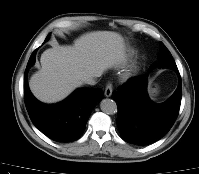 File:Abdominal aortic aneurysm (Radiopaedia 22421-22458 non-contrast 5).jpg