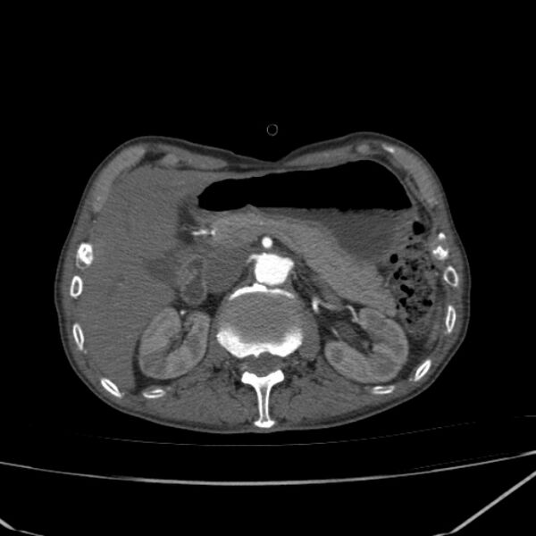 File:Abdominal aortic aneurysm (Radiopaedia 23703-23856 Axial C+ arterial phase 21).jpg