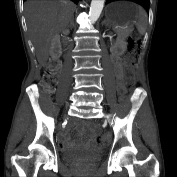 File:Abdominal aortic aneurysm (Radiopaedia 23703-23856 Coronal C+ arterial phase 19).jpg