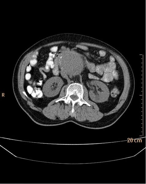 File:Abdominal aortic aneurysm (Radiopaedia 25985-26121 Axial non-contrast 9).jpg