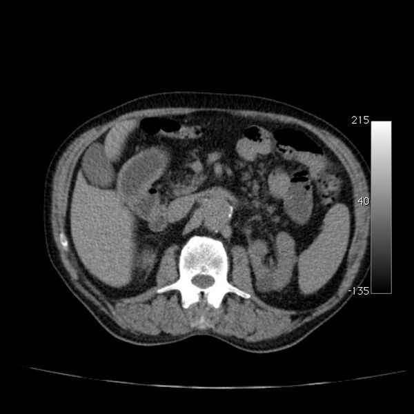 File:Abdominal aortic aneurysm (Radiopaedia 29248-29660 Axial non-contrast 22).jpg