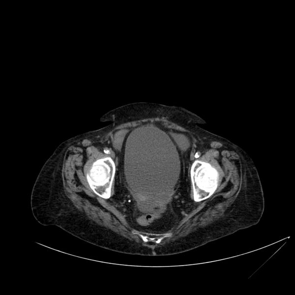 File:Abdominal aortic aneurysm - impending rupture (Radiopaedia 19233-19246 Axial non-contrast 112).jpg