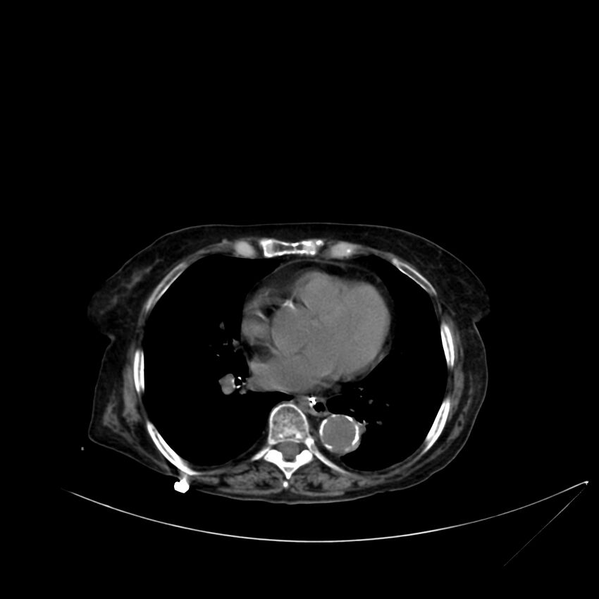 Abdominal aortic aneurysm - impending rupture (Radiopaedia 19233-19246 Axial non-contrast 4).jpg