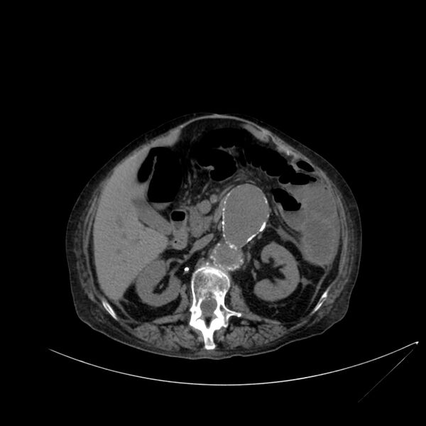 File:Abdominal aortic aneurysm - impending rupture (Radiopaedia 19233-19246 Axial non-contrast 52).jpg