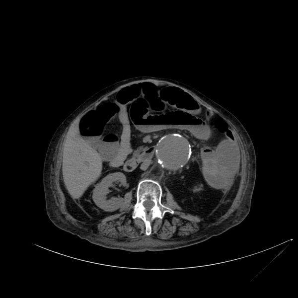 File:Abdominal aortic aneurysm - impending rupture (Radiopaedia 19233-19246 Axial non-contrast 61).jpg