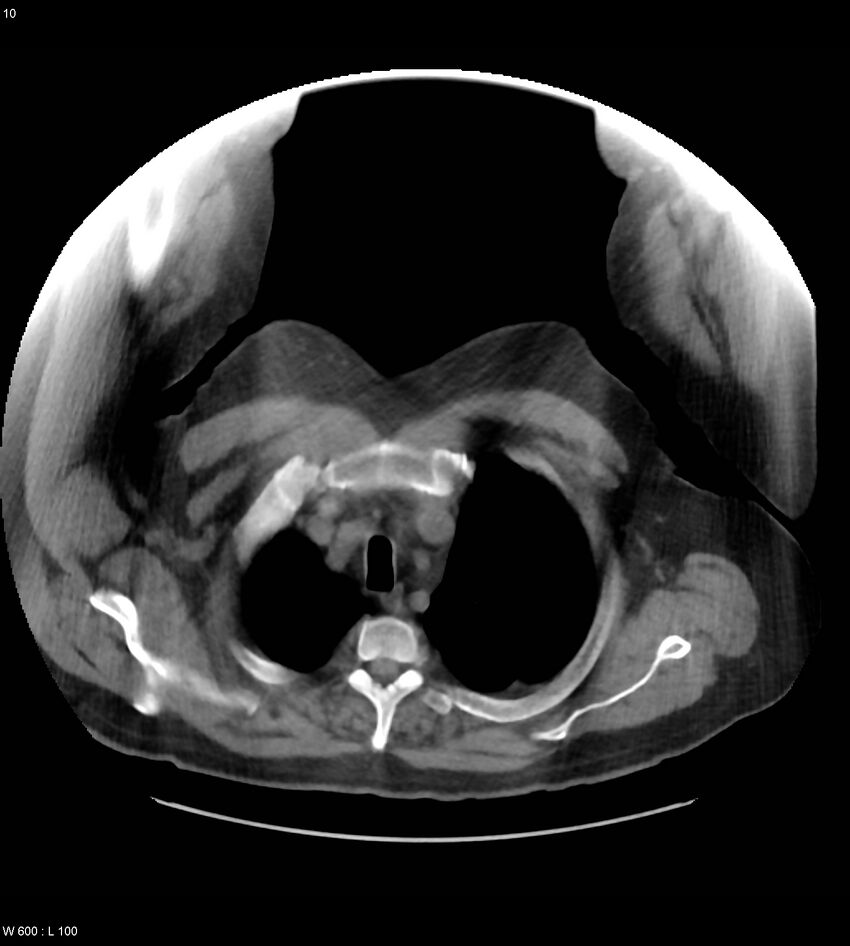 Abdominal aortic aneurysm with intramural hematoma then rupture (Radiopaedia 50278-55631 Axial non-contrast 6).jpg