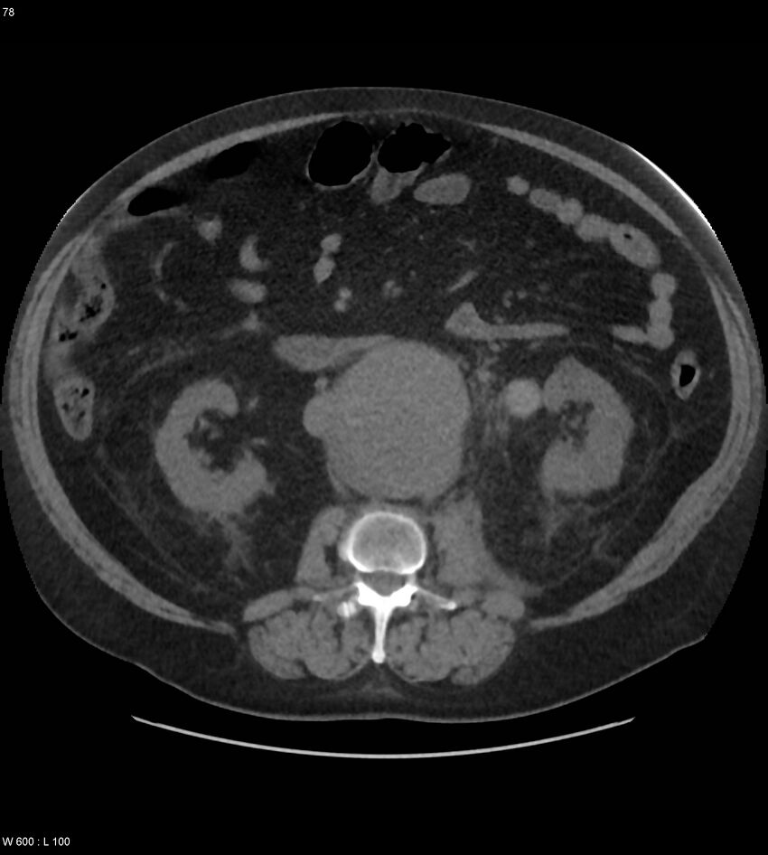 Abdominal aortic aneurysm with intramural hematoma then rupture (Radiopaedia 50278-55631 Axial non-contrast 74).jpg