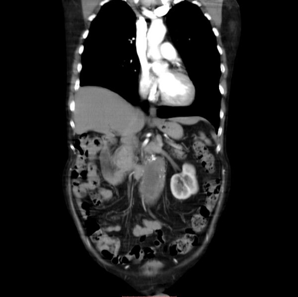File:Abdominal aortic interposition tube graft and aneurysm thrombosis (Radiopaedia 71438-81857 Coronal C+ arterial phase 11).jpg