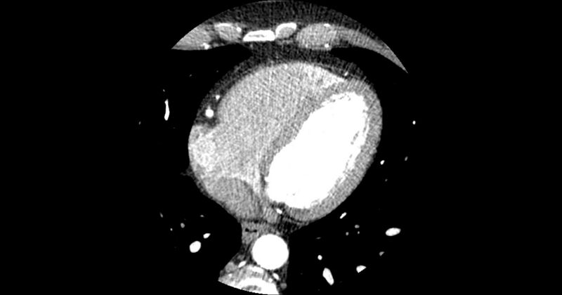 File:Aberrant left main coronary artery (ALMCA) arising from the right sinus with interarterial course (Radiopaedia 63251-71814 Axial C+ arterial phase 132).JPG