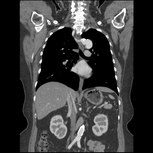 File:Aberrant right subclavian and left vertebral arteries (Radiopaedia 43467-46847 Coronal C+ portal venous phase 49).jpg