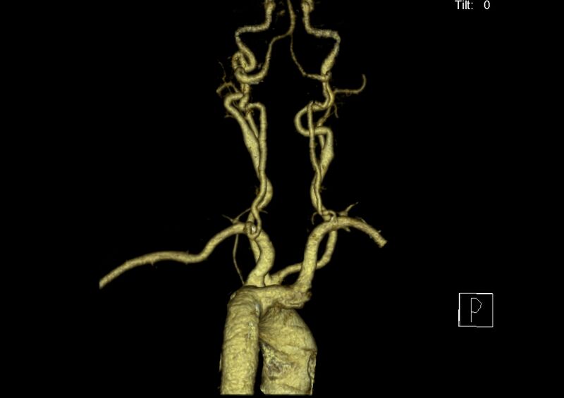 File:Aberrant right subclavian artery (Radiopaedia 19283-19294 3D reconstruction C+ arterial phase 22).jpg