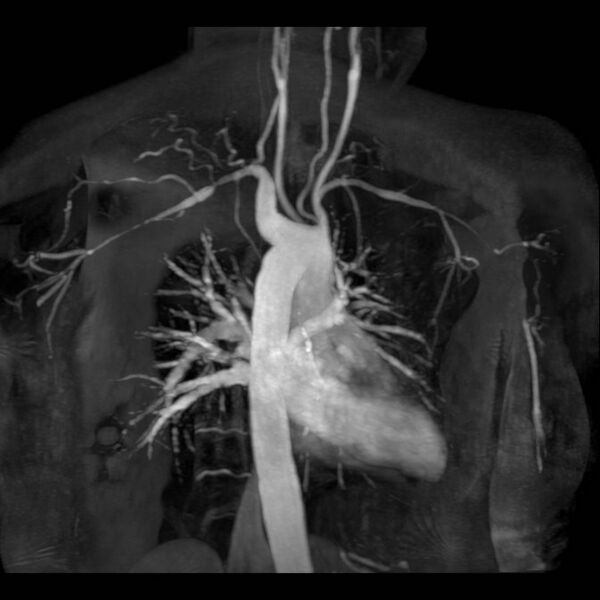 File:Aberrant right subclavian artery with background Takayasu arteritis (Radiopaedia 21423-21363 MRA 8).jpg