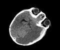 Abusive head trauma (Radiopaedia 70205-80252 Axial non-contrast 12).jpg