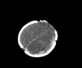 Abusive head trauma (Radiopaedia 70205-80252 Axial non-contrast 26).jpg