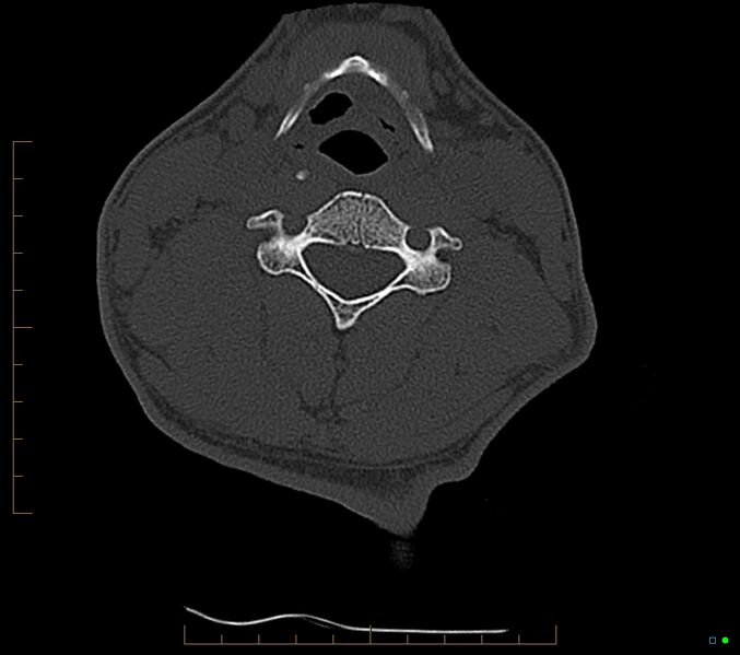 File:Accessory articulation of cervical transverse processes (Radiopaedia 82715-96933 Axial non-contrast 70).jpg