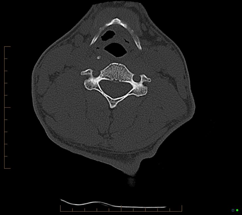 Accessory articulation of cervical transverse processes (Radiopaedia 82715-96933 Axial non-contrast 70).jpg
