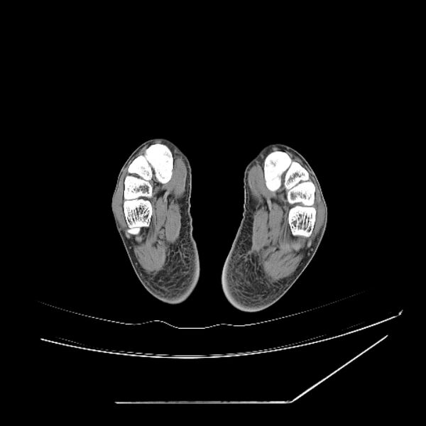 File:Accessory soleus muscle (Radiopaedia 61069-68943 Axial non-contrast 76).jpg