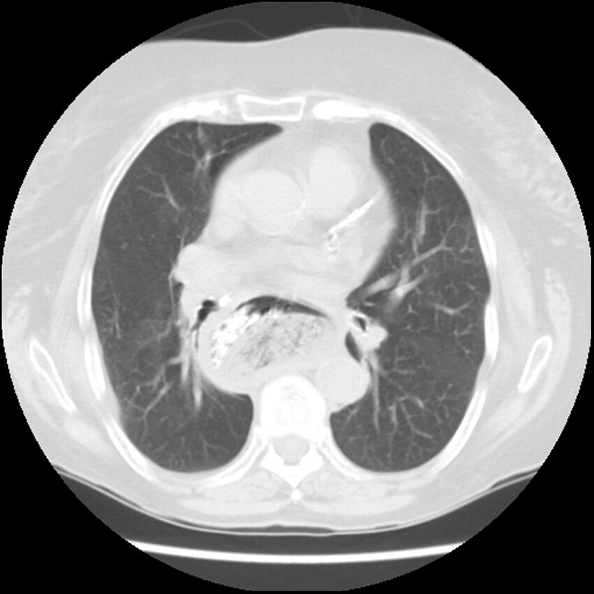 Achalasia (Radiopaedia 44094-47649 Axial lung window 30).jpg