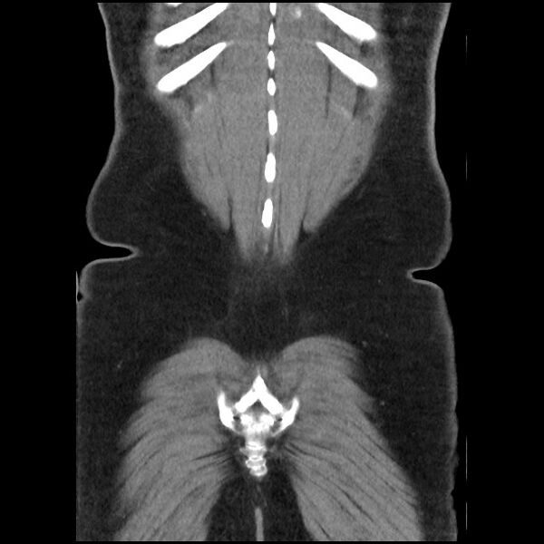File:Active colonic bleed on CT (Radiopaedia 49765-55025 Coronal non-contrast 50).jpg